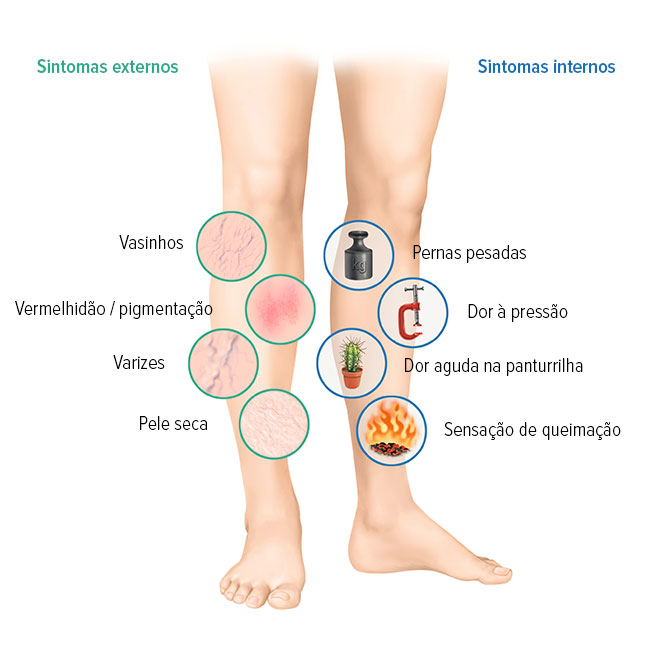 Sintomas de problemas venosos Sintomas de problemas venosos