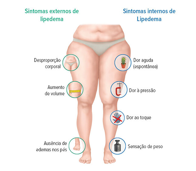 Sintomas do lipedema Sintomas do lipedema