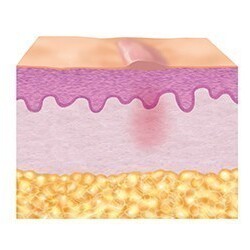 3. Reparatiefase (epithelisatie)