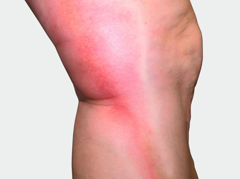 Beininnenseite, an der man eine rote Verfärbung sieht