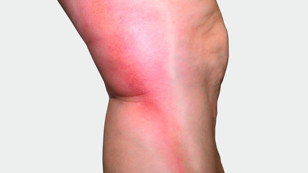 Beininnenseite, an der man eine rote Verfärbung sieht