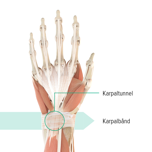 Anatomisk illustration af venstre hånd med markering af karpaltunnelen og karpalleddet Anatomisk illustration af venstre hånd med markering af karpaltunnelen og karpalleddet