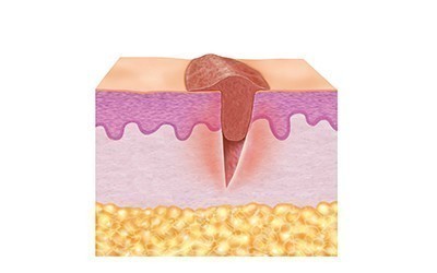 2. Granulationsfase (proliferationsfase)